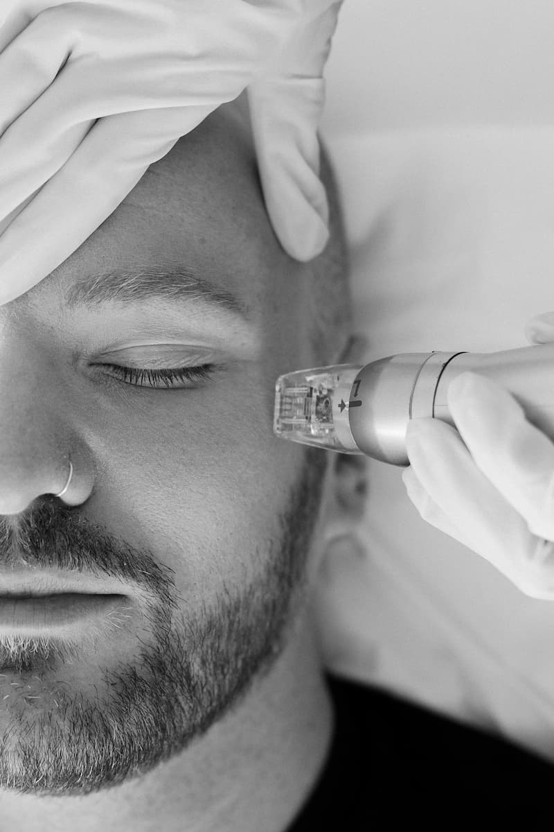 Rf Microneedling Portrait