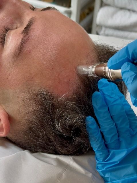 a person getting hair stimulating injection done
